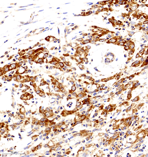 02 GB11080_Cytochrome C_7116070501 H breast cancer d2000_30.0x_IHC.jpg