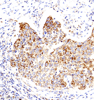 03 GB11080_Cytochrome C_7116070501 H lung cancer d2000_30.0x_IHC.jpg