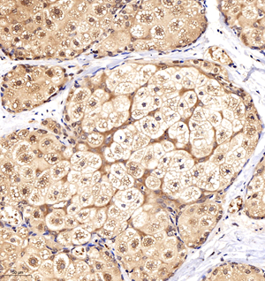 04 GB11099_16916100801 GSK3 H ovary cancer d1200_20.0x_IHC.jpg