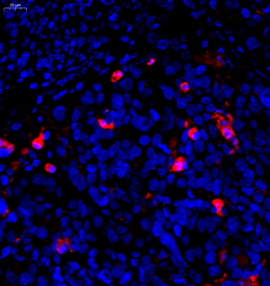 10 GB11532_c-caspase3_H subcutaneous transplant tumor（SW480） d1200_40.0x_IF.jpg