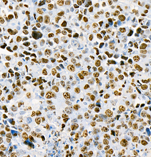 02 GB111141_Ki67_5405_M subcutaneous transplant tumor（H22） d500_40.0x_IHC.jpg