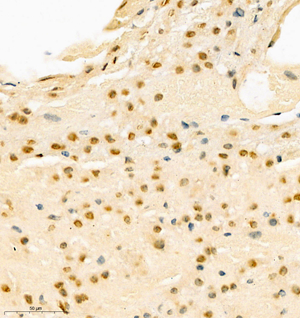 02 GB112254_201001_HES1_C134 H liver cancer d1000_40.0x_IHC.jpg