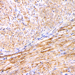 04 GB12959_20230522_cladesmon_5H4E12_5H4E12 20230404 H endometrial carcinoma d1000_IHC.jpg