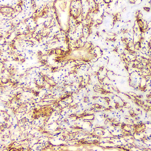 05 GB12959_20230522_cladesmon_5H4E12_5H4E12 20230404 H breast invasive ductal carcinoma d1000_IHC.jpg