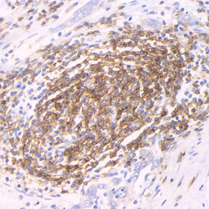 02 GB15061_20230522_CD19_ZSM22017_ZSM22017230424 H gastric carcinoma d1000_40.0x_IHC.jpg