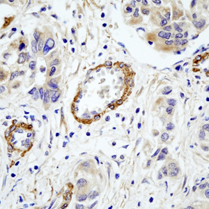 05 GB115483_14241-3_C6_ H  liver cancer   d100_40.0x_IHC.jpg