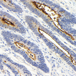 01 GB154939_20230424_MUC1_H53_H5320230413 H rectal cancer d1000_40.0x_IHC.jpg