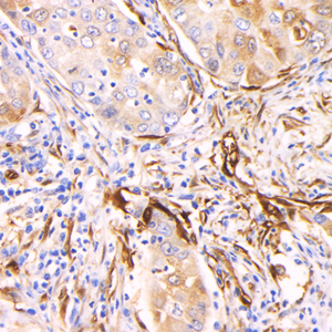 02 GB155215_20230522_TGM2_H5220_H5220230413 H lung cancer d1000_40.0x_IHC.jpg