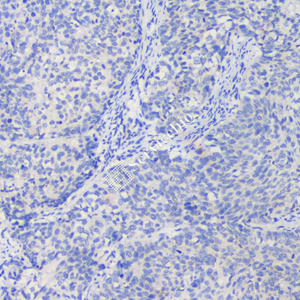 011 GB121012_20230522_NapsinA_4H10H7_4H10H7 20230404 H  Lung squamous cell carcinoma d1000_IHC.jpg