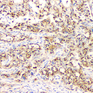 012 GB121012_20230522_NapsinA_4H10H7_4H10H7 20230404 H Non-small cell lung cancer    d1000_IHC.jpg