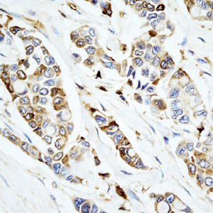 07 GB115508_14565-2_S100A1_ H   breast cancer d200_40.0x_IHC.jpg
