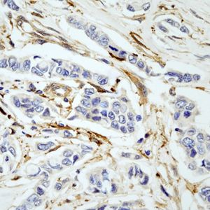 04 GB115509_14575-2_GSN_  H breast cancer d100_40.0x_IHC .jpg