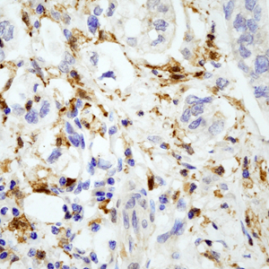 05 GB115509_14575-2_GSN_  H gastric  cancer d100_40.0x_IHC .jpg