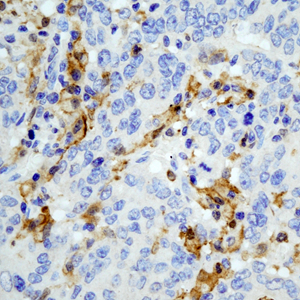 06 GB115509_14575-2_GSN_ H colon cancer d100_40.0x_IHC.jpg