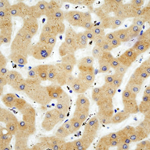 05 GB115505_14555-2_PON1_ M liver cancer d200_40.0x_IHC.jpg