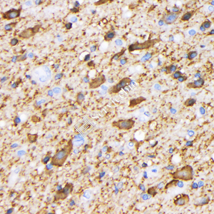 01 GB115559_01_MAP2_1095_109517110802_d1500_H glioblastoma multiforme_40.0x_IHC.jpg