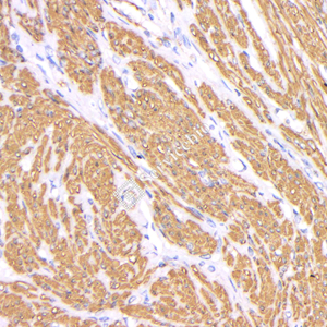 03 GB12044_20230625_a-smA_18F11A3_ 20230526_d1000_H endometrial carcinoma_ IHC.jpg