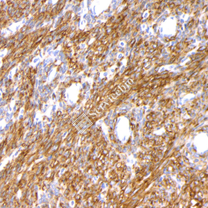 06 GB12960_20230625_caldesmon_3A3G9_ 20230517_d1000_H endometrial cancer_ IHC.jpg