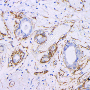 08 GB12960_20230625_caldesmon_3A3G9_ 20230517_d1000_H breast cancer_ IHC.jpg