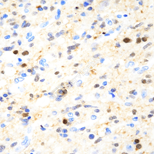 01 GB15359_20230620_S100B_ZSM20071_ZSM20071230529 H glioblastoma multiforme d500_40.0x_IHC.jpg