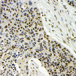 03 GB115547_20230627_TARDBP_14738_2 H esophageal cancer d100_40x_IHC.jpg