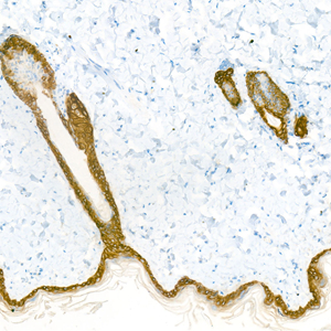 02 GB12803_CK14_2H1H2_d500_M skin_26.5x_IHC.jpg