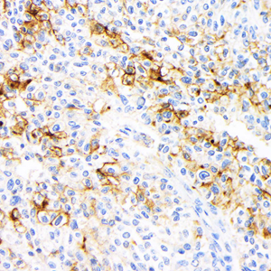 02 GB12017_20230721_CA125_4H1G2_ 20230531_d1000_H ovarian cancer_ IHC.jpg