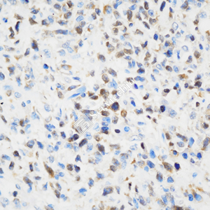 03 GB115600_20230724_caspase3_C1662 05_C166221113005 H T-cell lymphoma d700_40.0x_IHC.jpg