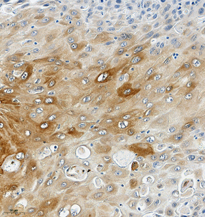 01 GB115588_CSTB_14778-2_1477822122702-2 H esophageal carcinoma d150_IHC_20.0x.jpg