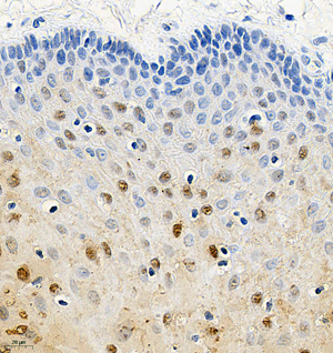 02 GB115588_CSTB_14778-2_1477822122702-2 H esophageal carcinoma d150_IHC_40.0x.jpg