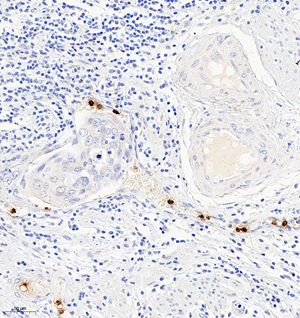 01 GB115589_P14ARF_14779-2_1477922122702-2 H cervical carcinoma d200_IHC_20.0x.jpg