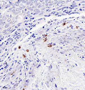 02 GB115589_P14ARF_14779-2_1477922122702-2 H cervical carcinoma d200_IHC_40.0x.jpg