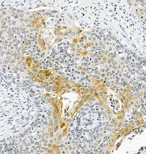 01 GB115576_HDAC4_13950-3_1395022072802-3 H cervical carcinoma d150_IHC_20.0x.jpg