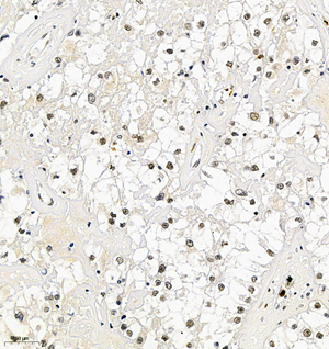 02 GB115576_HDAC4_13950-3_1395022072802-3 H renal carcinoma d50-150_IHC_20.0x.jpg