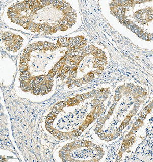 01 GB115577_Cathenapsinl_13959-3_1395922072802-3 H endometrial cancer d150_IHC_20.0x.jpg