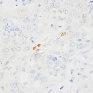 01 GB15153_P21_ZCM21118_d1000_H cervical carcinoma_40.0x_IHC.png