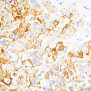 02 GB15803_Cytokeratin 14_ZSM19027_d1000_H esophageal carcinoma_40.0x_IHC.png