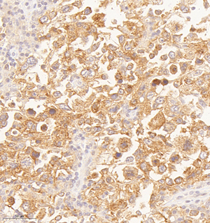 01 GB14045 CD71_H diffuse Large b-cell lymphoma d200_30.0x_IHC(1).jpg