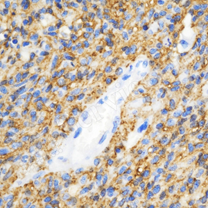 10 GB11529_AQP4_d600_H glioblastoma multiforme_40x_IHC.jpg