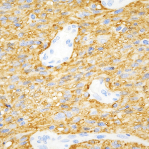 07 GB12529_AQP4_d1000_H glioblastoma multiforme_40x_IHC.jpg