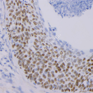01 GB12900_P63_2H5A7_20230517_d1000_H cervical carcinoma_IHC_WM.png