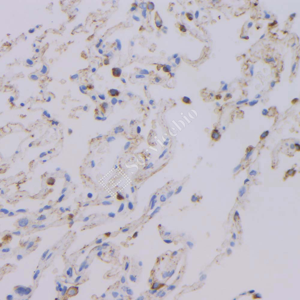 02 GB12989_surfactant_7A6H5_7A6H5 20230304_d1000_H lung cancer_IHC_WM.png