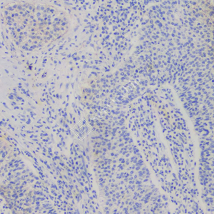 03 GB12989_surfactant_7A6H5_7A6H5 20230304_d1000_H Lung squamous cell carcinoma_IHC_WM.png