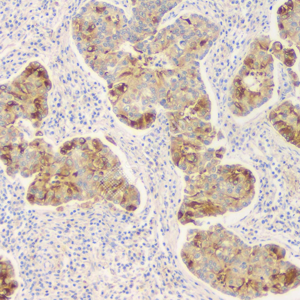 04 GB12989_surfactant_7A6H5_7A6H5 20230304_d1000_ lung adenocarcinoma_IHC_WM.png