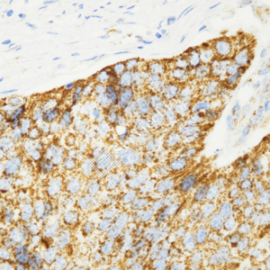 01 GB15186_TLR4_ZCM17020_ZCM17020230823_d1000_H esophageal carcinoma_40.0x_IHC_WM.png