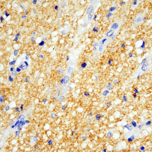 02 GB15553_SYP_ZCM22128_ZCM22128230725_d500_H glioblastoma multiforme_40.0x_IHC_WM.png