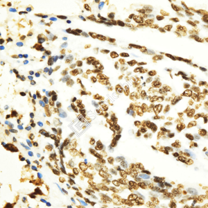 02 GB151957_MLH1_ZCM22134_ZCM22134230823_d1000_H esophageal carcinoma_40.0x_IHC_WM.png