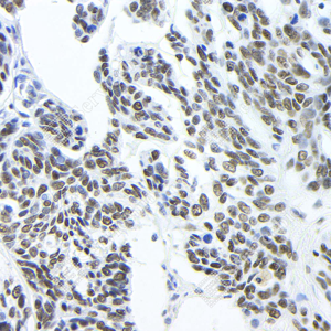03 YB12172_MUM1_1E10E7_1E10E7 20230921_d300_H_esophageal carcinoma_40.0x_IHC-WM.png