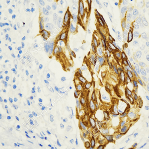 01 GB15805_CK16_ZCM21110_ZCM21110230818_d1000_H_esophageal carcinoma_40.0x_IHC-WM.png