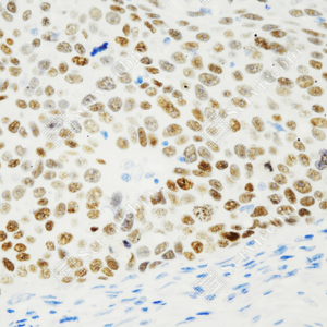 02 GB150003_p40-DeltaNp63_ZCR21076_ZCR21076230621_d1000_H_esophageal carcinoma_40.0x_IHC.png